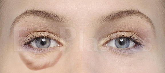 Cosmetic eyelid surgery, Blepharoplasty, Eyelift